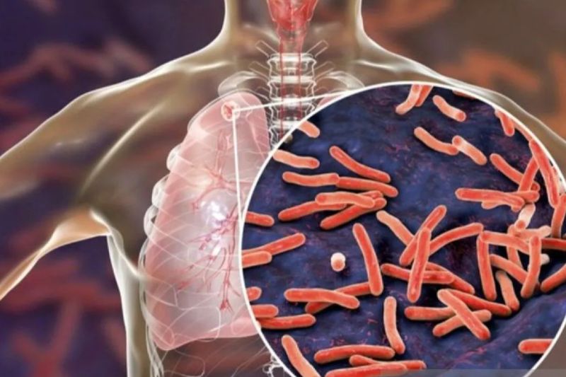 Kontak Erat di Lingkungan Rumah jadi Faktor Kuat Penularan TBC anak TBC